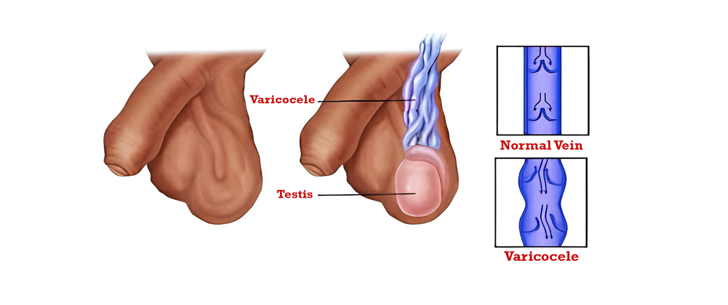 Varicocele