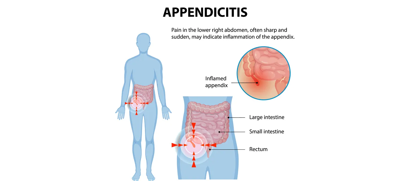 Appendicitis