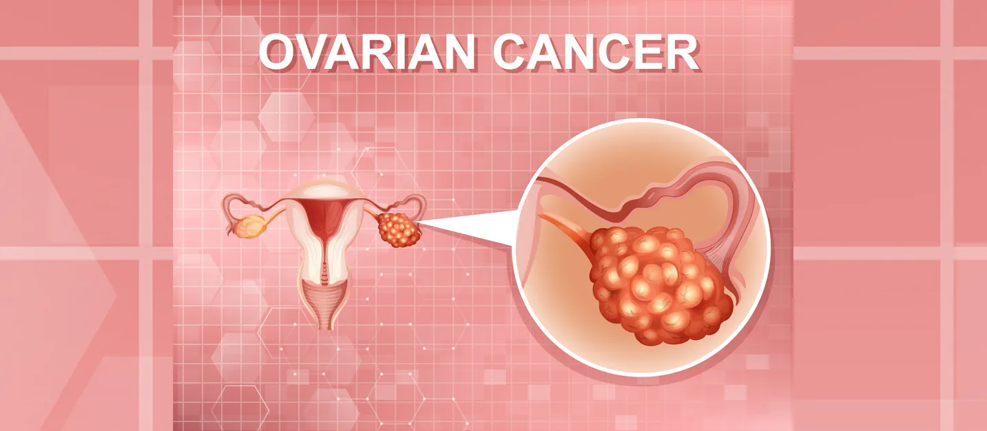 ovarian-cancer