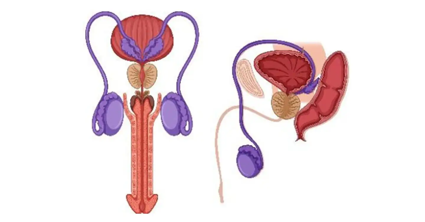 Varicocele